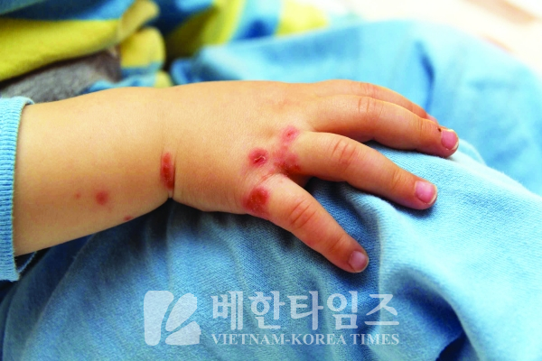 Bệnh chân tay miệng tiếng Hàn là gì?
